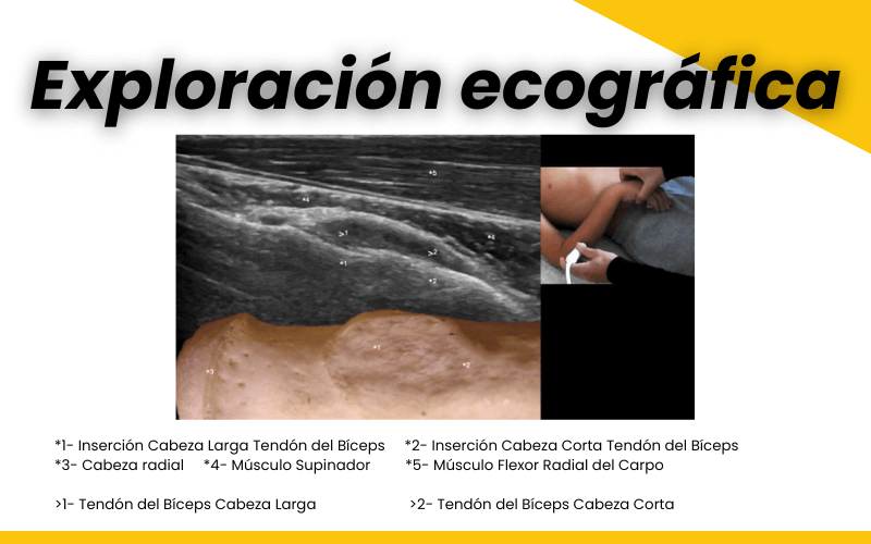 3. Ecografia tendon distal biceps tempo formacion.png